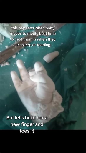 Creating a Comfortable Baby Cast: Tips and Tricks