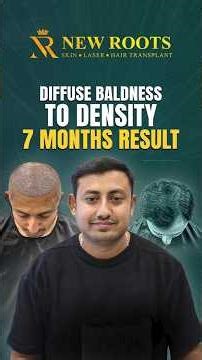 Baldness Solution, Best Treatment | Hair Transplant in Nagpur #baldnesssolution #shorts