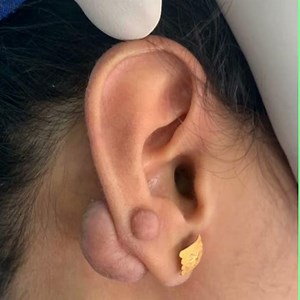 Keloid on Ear caused by SECOND STUD PIERCING | Earlobe repair surgery | Before and After pics