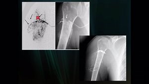 Use of Liquid Embolic Agents