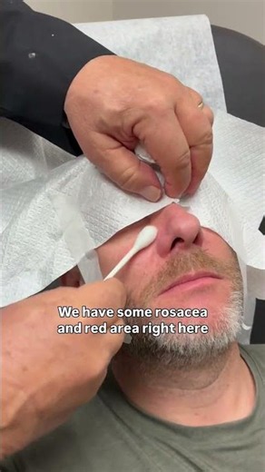 Dermatologist with 50 Years of Experience uses TCA Peel to treat male patient's rosacea👨🏻‍⚕️