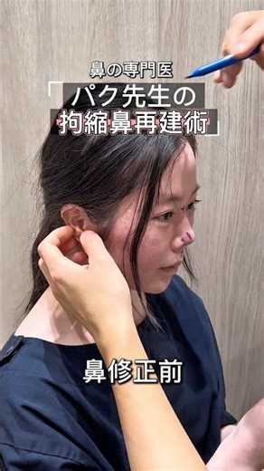 拘縮鼻再建手術から1か月後✨#鼻翼縮小 #鼻整形 #鼻中隔延長 #団子鼻 #渡韓整形 #鼻尖形成 #整形レポ #鼻整形ダウンタイム #鼻フル #小鼻縮小 #鼻プロテーゼ #ビフォアーアフター