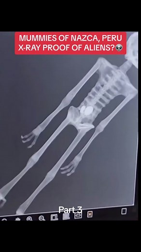 Alien or just Ancient? 🛸 Nazca mummies are put under X-ray…decide for yourself! 👽 Are we unlocking secrets of our ancient ancestors or proof of extraterrestrial encounters? What do you think? Part 3 #NazcaUncovered #aliens #ufo #AlienFootage #Extraterrestrial #NazcaMummies #alientheory #xraychallenge #extraterrestrialevidence #AncientAliens #TikTokMystery #hallucinationhippies #nazca #peruanos