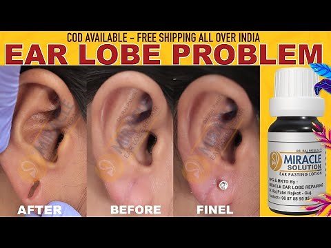 How to repair big ear hole,Ear lobe repair without stiches #earhole #skincare #earloberepair