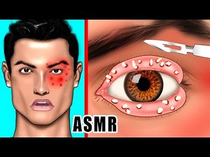 How to Help Ronaldo?Eyelid Sebum Extrusion ASMR Animation Eye Stone Removal & Meibomian Gland Care