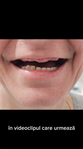 ✨ Bucuria unui nou început începe cu un zâmbet! Astăzi am redat pacienților noștri nu doar dinții, ci încrederea și plăcerea de a zâmbi din nou. 🦷 Implanturi dentare și dinți fixați imediat — confort, estetică și rezultate imediate.💫 Botesan Clinique – zâmbește din nou cu încredere! | Botezan Bogdan