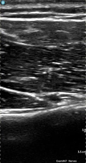 Axillary nerve - posterior quadrangular space #anatomy