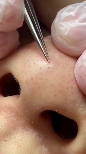 #blackhead #blackheads #blackheadextraction #blackheadremovals #head #cleaning #beauty #lifestyle #women #beautyroutine