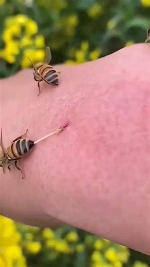 How to Remove a Bee Stinger Safely (Most People Do It Wrong) #facts