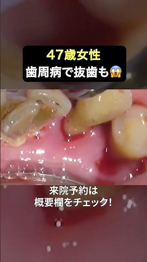 Severe periodontal disease can easily cause teeth to fall out 😢 #TheWhiteDentalClinic #Dentist #T...