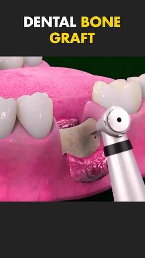 Explaining The Dental Bone Graft Procedure (3D Animation)