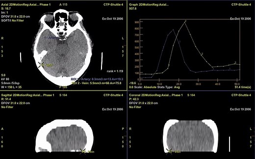 灌注CT Perfusion 4D后处理软件操作演示