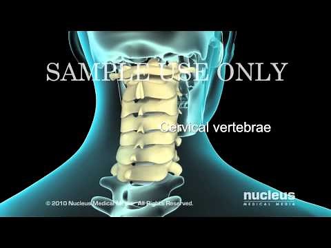 Lumbar Laminectomy