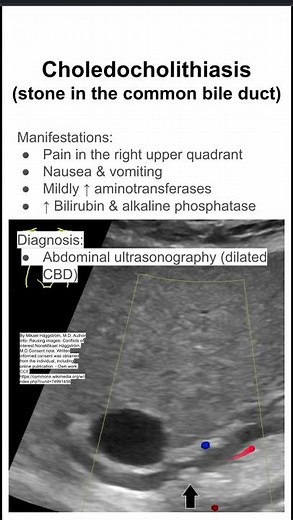 Choledocholithiasis (stone in the common bile duct)