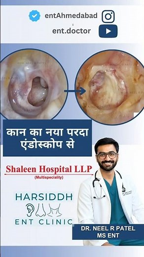A diabetic eardrum perforation and hearing loss to complete healing! Dr Neel Patel MS ENT