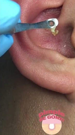 Massive ‘exploding’ back cyst