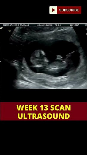 ultrasound scan week 13 | pregnancy week by week