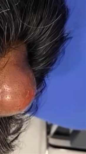 Oddly satisfying! Let's Clean Up 2025❤️❤️ | Dr. Pimple Popper