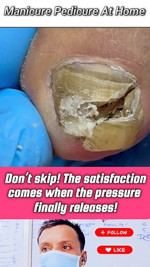 23K views · 113 reactions | ⬛⬛“Hidden Black Dirt Under Yellow Nail — Removal” #DirtyNailCleaning #FootHygiene #DeepDebrisRemoval #manicure #asmr #nails #nailtech #treatment #caregiving #pedicurespa #relaxingvideo #satisfying | Manicure Pedicure At Home | Facebook