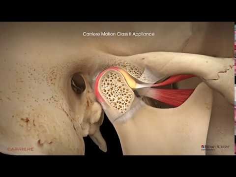 Carriere® Motion Clear™ Appliance with Clear Aligners Patient Education Animation