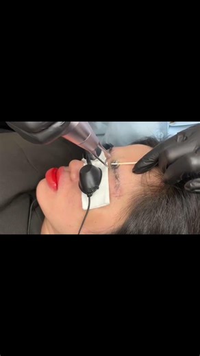 máy laser xóa xăm sửa máy xóa hình xăm tattoo