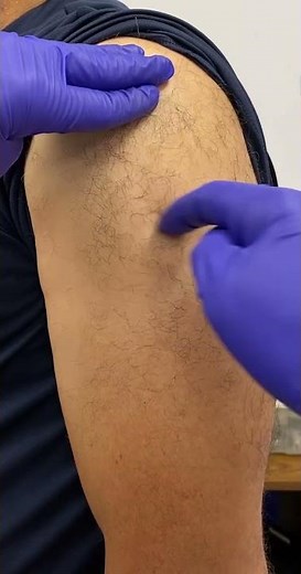 MHE Z Track Technique for IM Injections