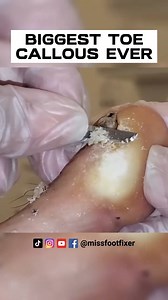 4.7K views · 32 reactions | SHAVING OF REAL BIG TOE CALLUS 禮 BIGGEST TOE CALLOUS EVER FULL TREATMENT BY MISS FOOT FIXER #callus #toecallusremoval #missfootfixer | Miss Foot Fixer | Facebook