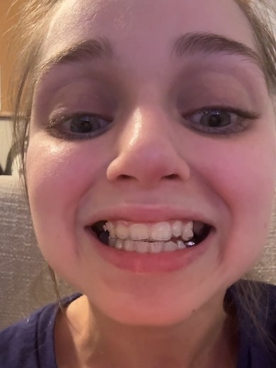 Facing Dental Challenges with Invisalign: Week 19 Update
