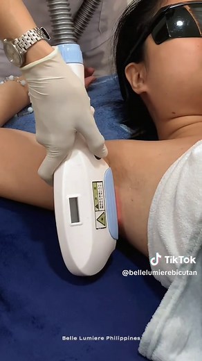 Effective Underarm Hair Removal with IPL Technology