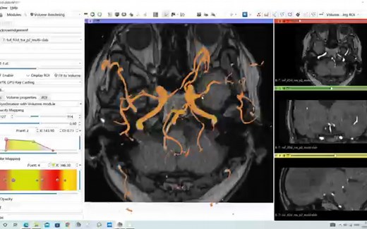 3D-slicer 3d tof血管渲染