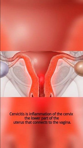 Your Body’s Silent Warning: What Cervicitis Is Trying to Tell You