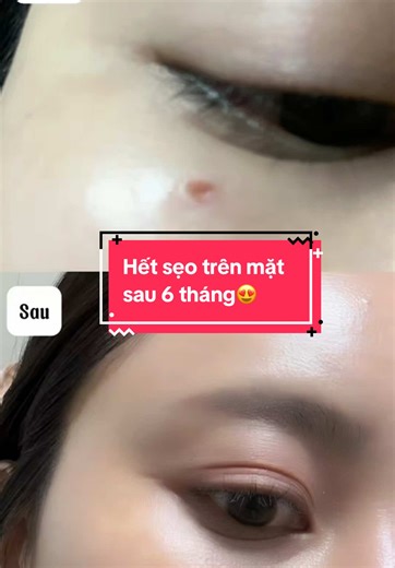 Kem trị sẹo Noscana, hết sẹo 6 tháng