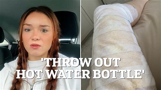 Woman-warning-hot-water-bottles-exploded-scarred-scalding-water.html