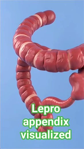 Appendix visualized #health and surgery with sami #appendix #appendectomy antomy #opration # foryou