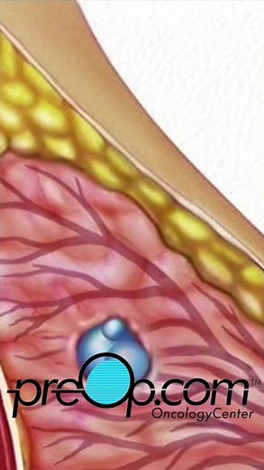 🔍 PreOp® Wire Localization Breast Biopsy Patient Ed 💡Master Key Steps Quickly✨ #shorts