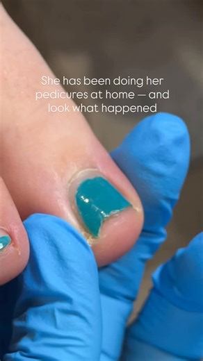 Natalie Zheltovski | Russian manicure education | AUSTIN TX on Instagram: "She has been doing her pedicures at home — and look what happened. I completely understand why many people prefer at-home pedicures: past traumatic salon experiences, budget considerations, busy schedules… there are many valid reasons, and I never judge. Today, I simply want to address this issue. Before I explain further, here’s an important note: this is not an ingrown toenail, and it has not invaded the skin yet. That 