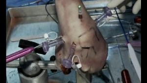 Anterior Bankart Repair - Surgery Demo