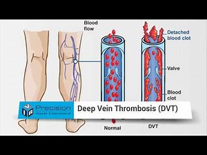 DVT a Solution for Blood Clots - Deep Vein Thrombosis