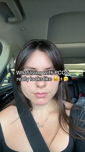 Yes, we can grow facial hair… this is called hirsutism. Hirsutism is a condition that affects at least 70% of woman with PCOS. It’s when too much hair grows in masculine places like our face, chest, back, and belly. It can be confusing because not all woman with PCOS have hirsutism and not all woman with hirsutism have PCOS. The difference is that hirsutism in woman with PCOS is triggered by the underlying hormonal imbalances like excess androgens, insulin resistance, and high cortisol (the root