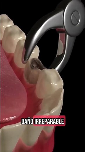 ¿Por qué realizamos una extracción dental?🦷