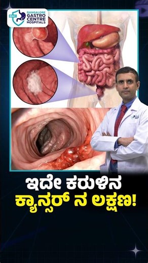 Don’t Ignore This Symptom! Early Sign of Colon Cancer You Must Know | Gut Health Warning