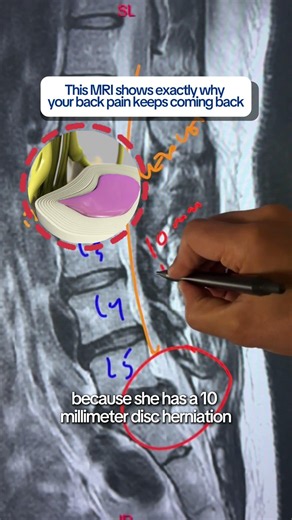 Spinal Decompression Cut 10mm Disc Herniation 30% Restored Mom’s Ability to Hold Baby #BackPain