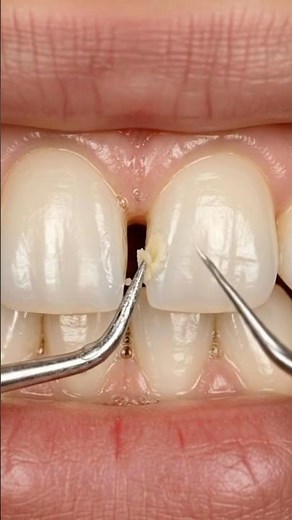 Deep Caries to Veneers: Anterior Tooth Transformation | #dentist #toothcraft #asmr #satisfying
