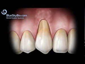 Patient Treatment Videos: Gingival Graft Alloderm