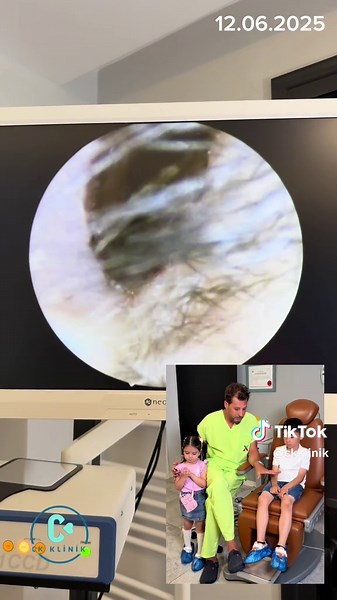 Understanding Nosebleeds in Children: Causes and Care