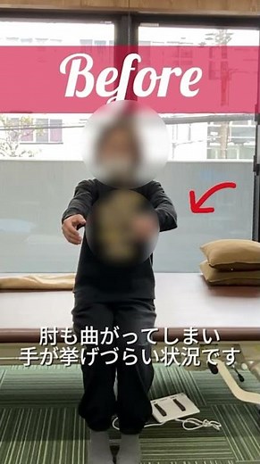 【発症後6か月】左片麻痺に対する上肢機能改善 ― 肩甲帯の過緊張と痛みの軽減を通した随意運動の再獲得#脳梗塞 #左片麻痺 #上肢リハビリ#家事動作 #肩甲帯#自費リハビリ #脳神経リハビリセンター