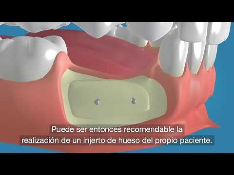 Injerto de hueso para implantes dentales | Clínica Dental MiBO Almería