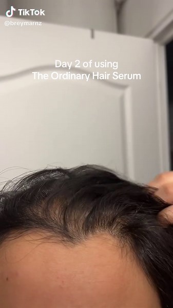 Day 2 of trying The Ordinary Hair Serum… Let’s see if TikTok was right about these hair growth results 👀 Documenting everything so other girlies with thinning hair don’t feel alone. #theordinaryhairserum #hairgrowthjourney #hairlosshelp #hairtok #hairgrowthtips