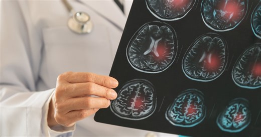 Ces symptômes d’un "mini AVC" qu’il ne faut jamais ignorer