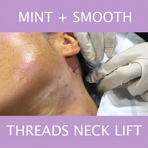 MINT+SMOOTH THREADS NECK LIFT by Dr. Tsay Ageless MD